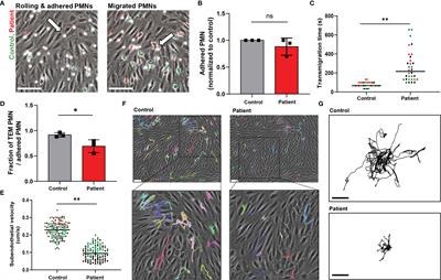 Defective Neutrophil Transendothelial Migration and Lateral Motility in ARPC1B Deficiency Under Flow Conditions